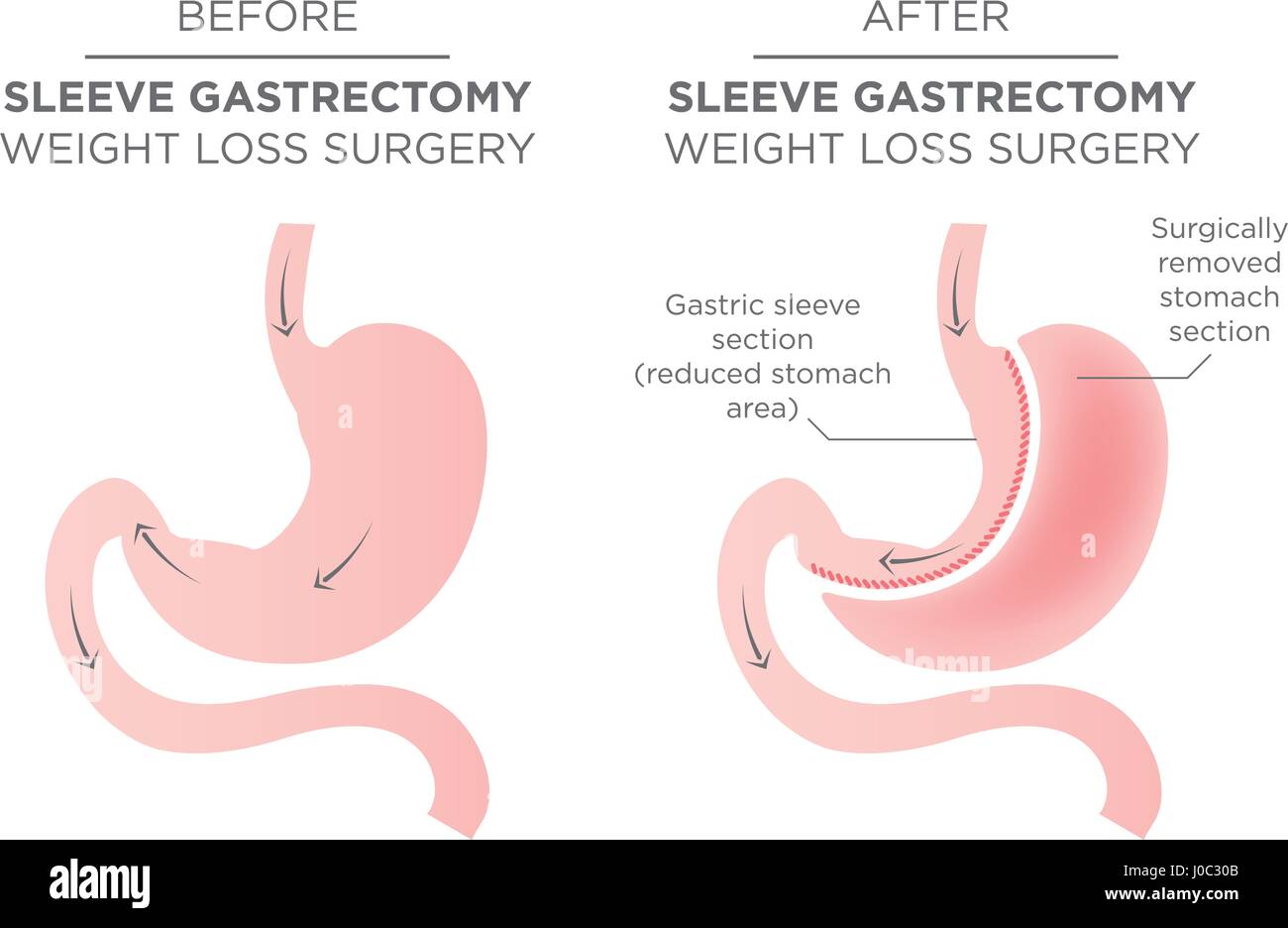 Stomach Staple Bariatric Surgery Resulting in 1/4 of Stomach Removed