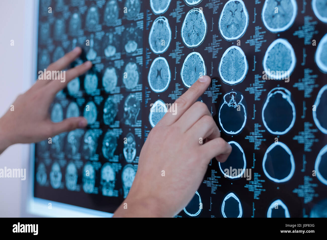 X ray images of human brain being put on the whiteboard Stock Photo