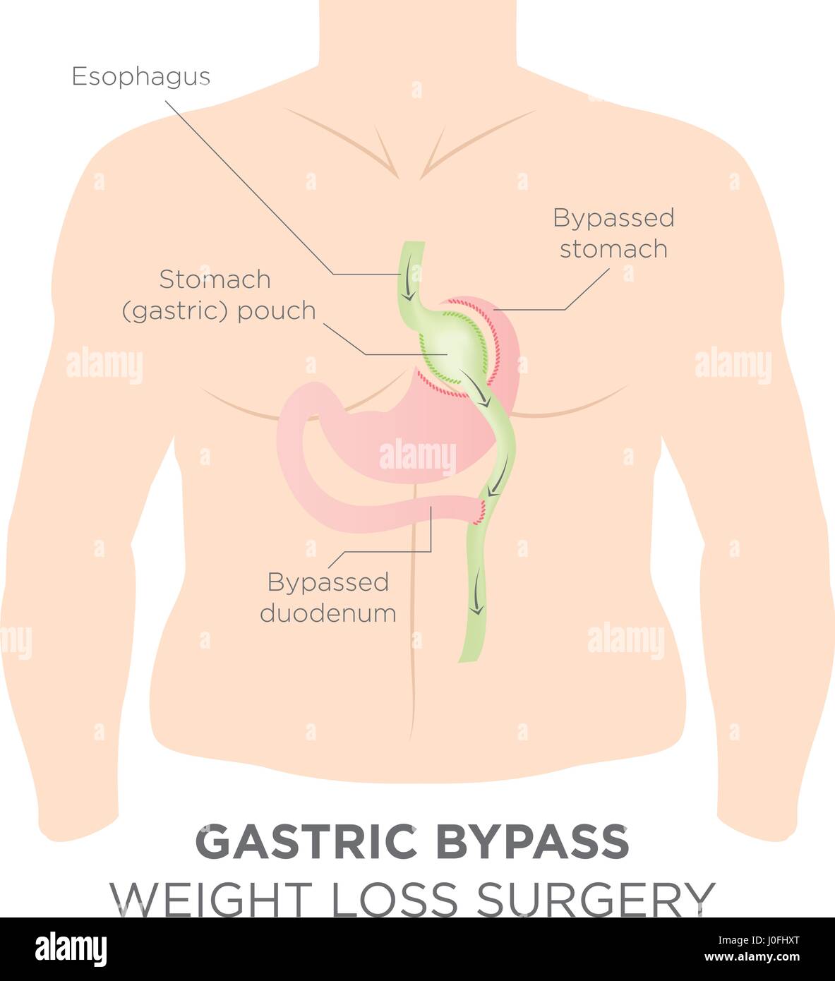 Gastric Bypass for Weight Loss - You Are Actually Re-routing Your Stomach in Order to Feel Full & Eat Less Stock Vector