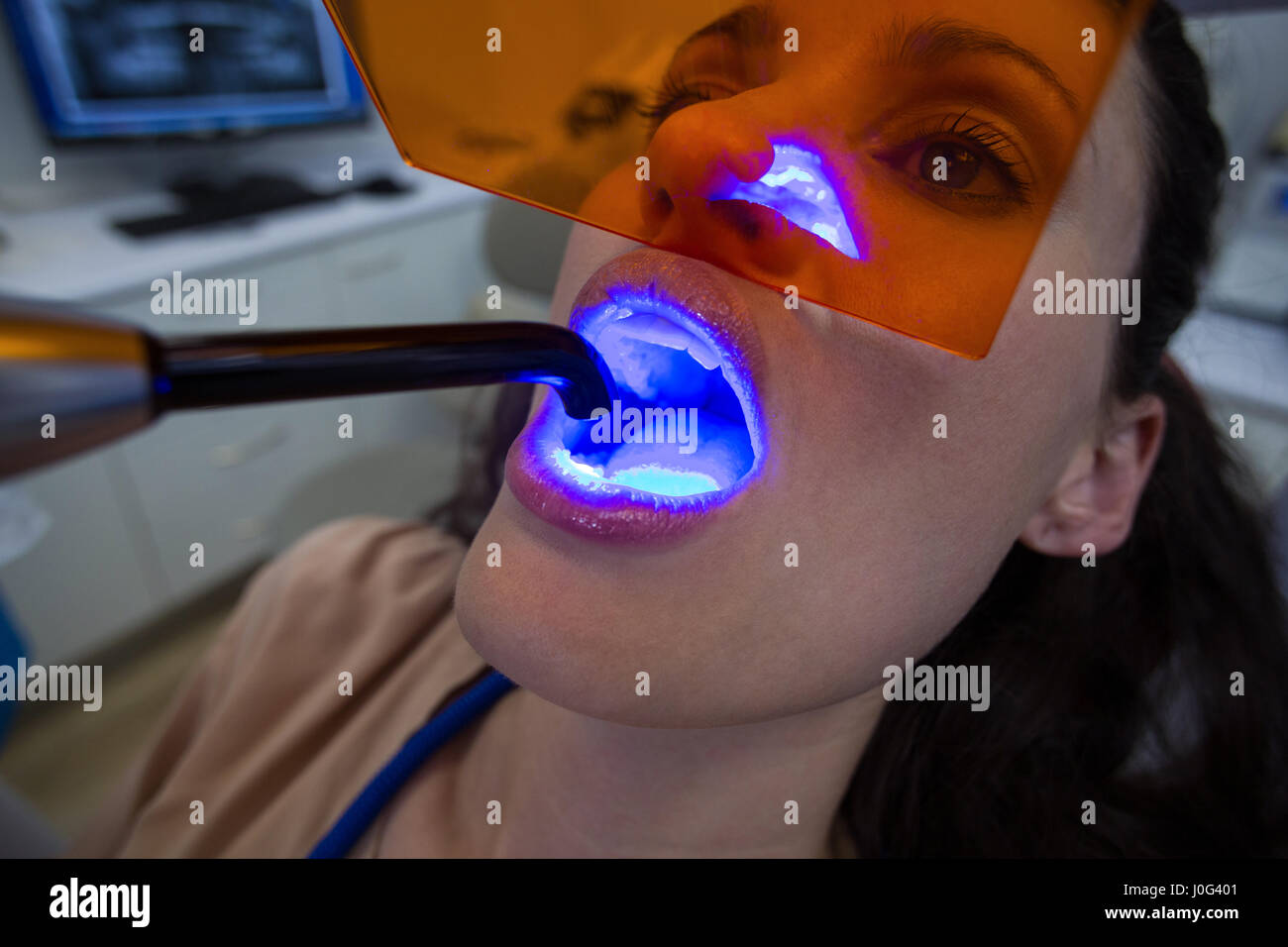 Dental uv light hires stock photography and images Alamy