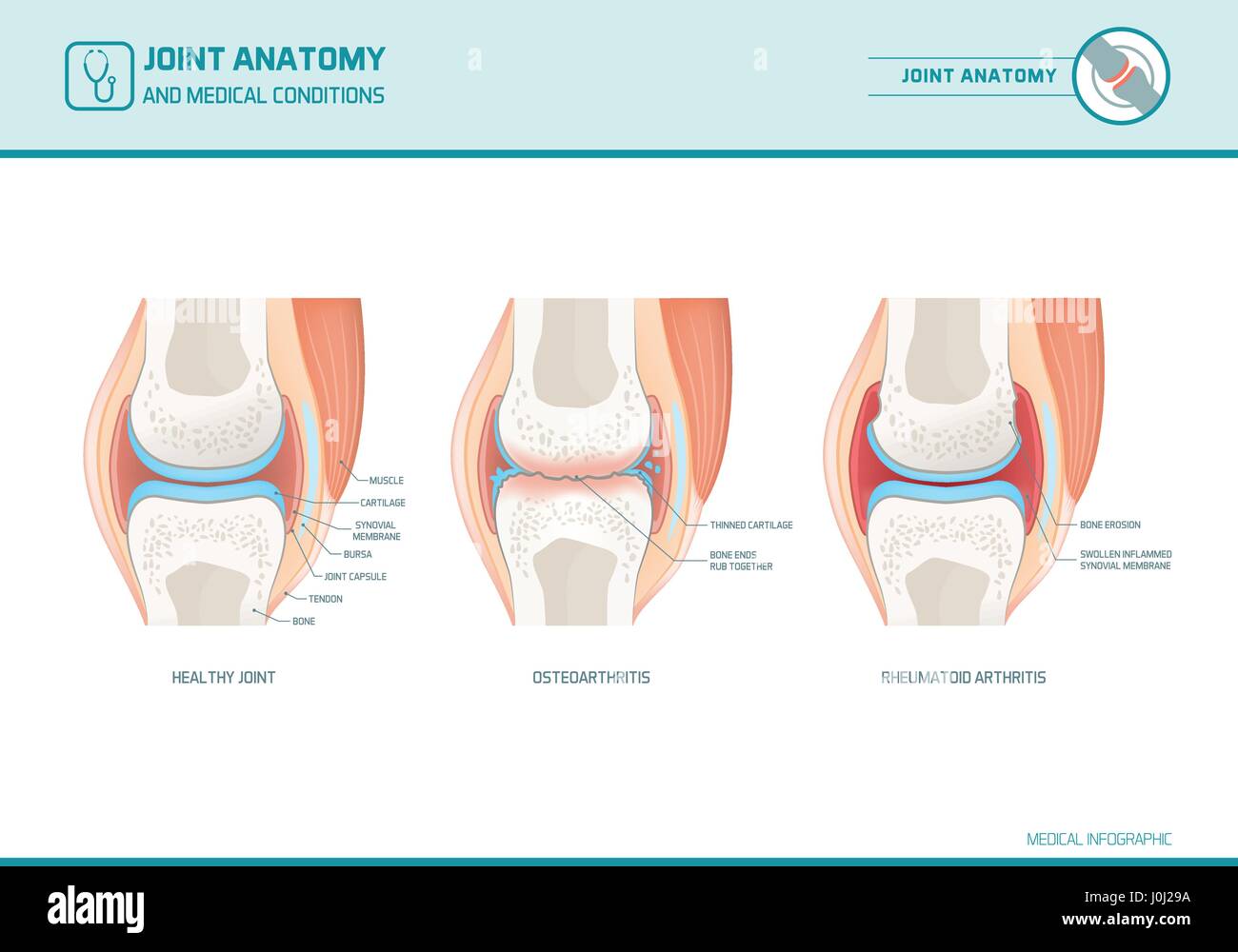 Joint anatomy, osteoarthritis and rheumatoid arthritis infographic with anatomical illustrations Stock Vector