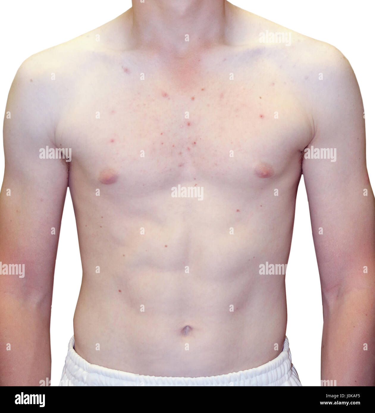 Photo of Teenage Boy Extreme Upper Body Acne Problem Stock Photo