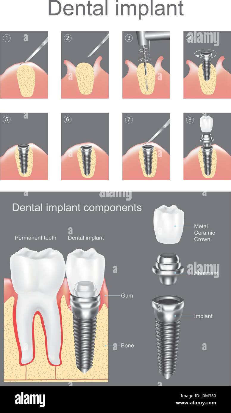 Dental implant is an artificial tooth root that is placed into your jaw to hold a replacement tooth or bridge. Dental implants may be an option for pe Stock Vector