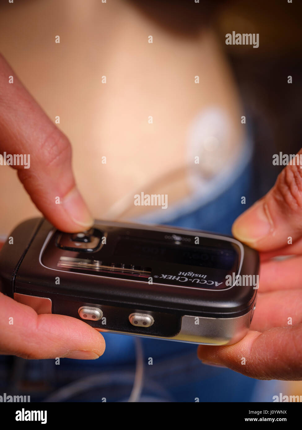 A woman with Type 1 diabetes using an insulin pump and continuous  glucose monitor. Stock Photo