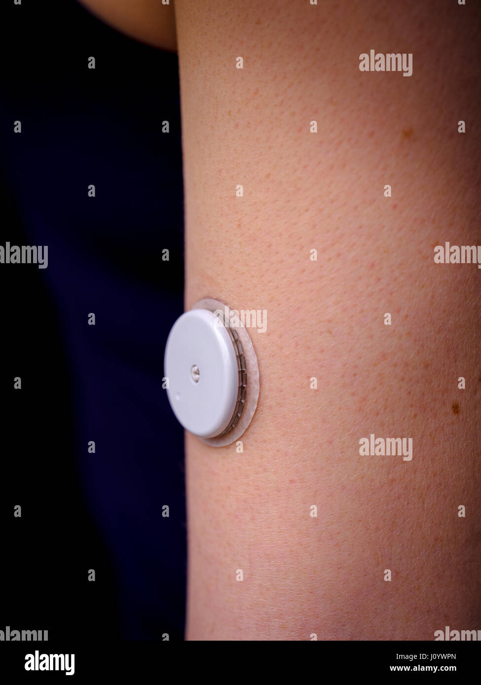 A woman with Type 1 diabetes using a flash glucose monitor called Freestyle Libre made by Abbott. Stock Photo