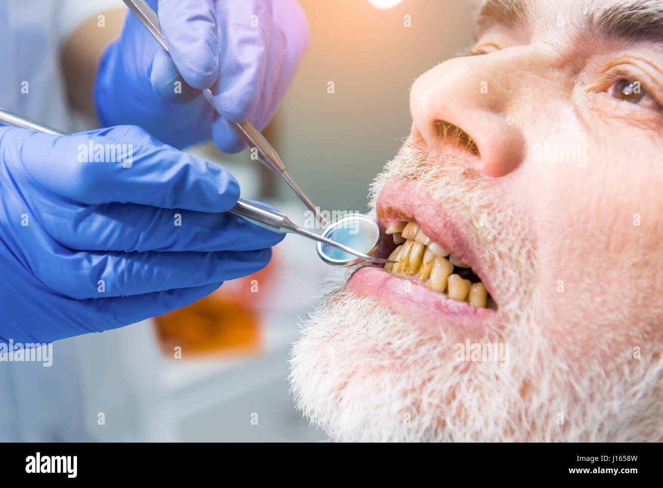 Dentist examining patient, close up. Elderly male with bad teeth
