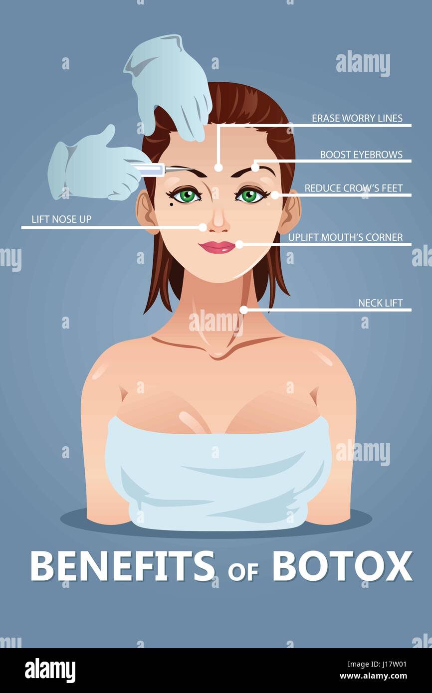 A vector illustration of benefits for botox infographic Stock Vector ...