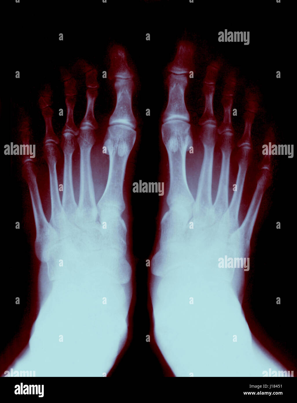 Foot fingers exposed on the xray Stock Photo Alamy