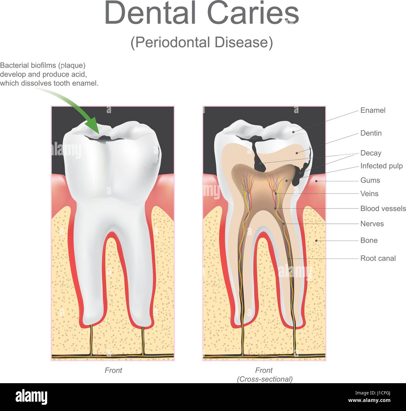 Dental caries is the scientific term for tooth decay or cavities. It is caused by specific types of bacteria. They produce acid that destroys the toot Stock Vector