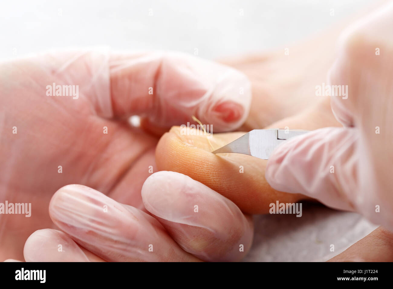 Podology. Removing the prints on the foot. Pedicure. Pedicure medicinal. Stock Photo