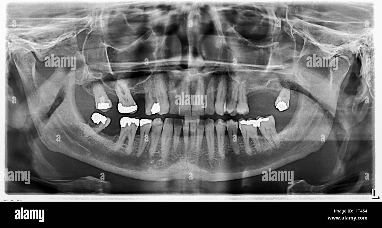 Dental X-Ray of a 50 year old man with one tooth having a cavity and an abscess. Stock Photo