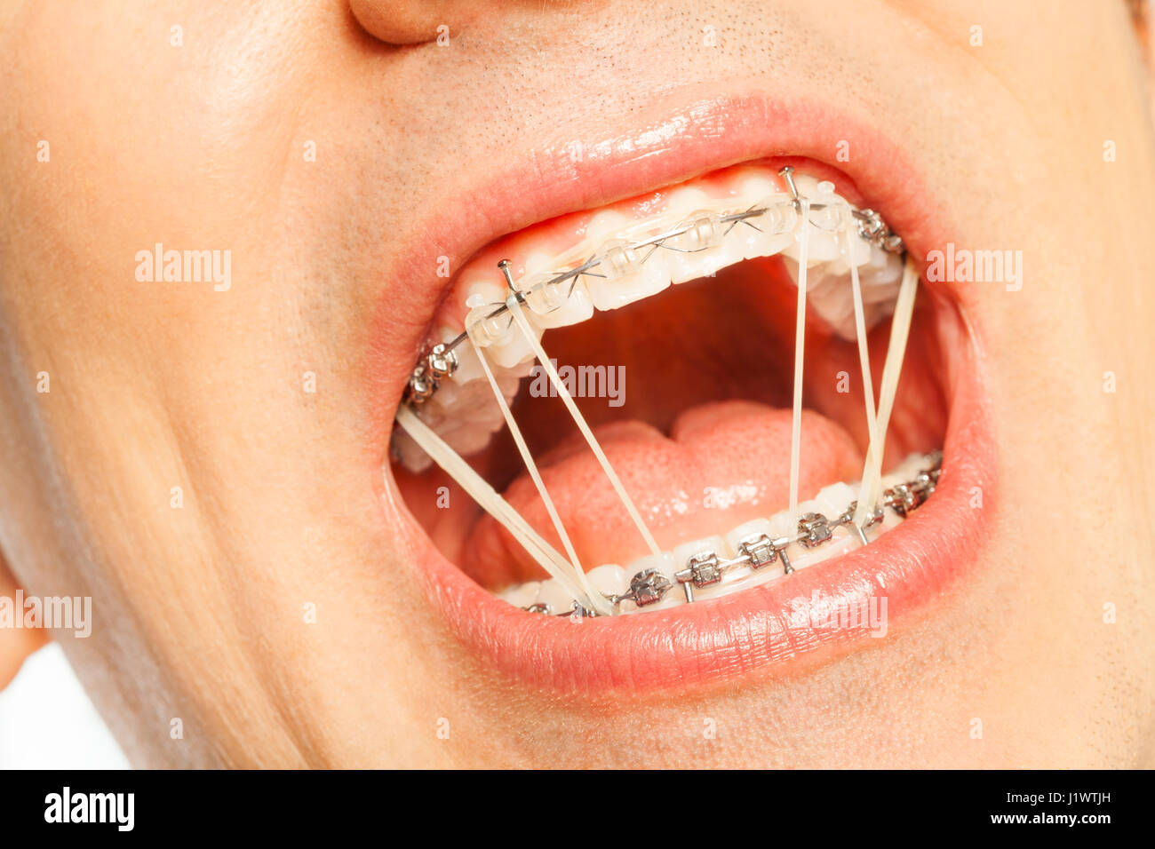Closeup of mouth of a man with orthodontic rubber strings on a braces