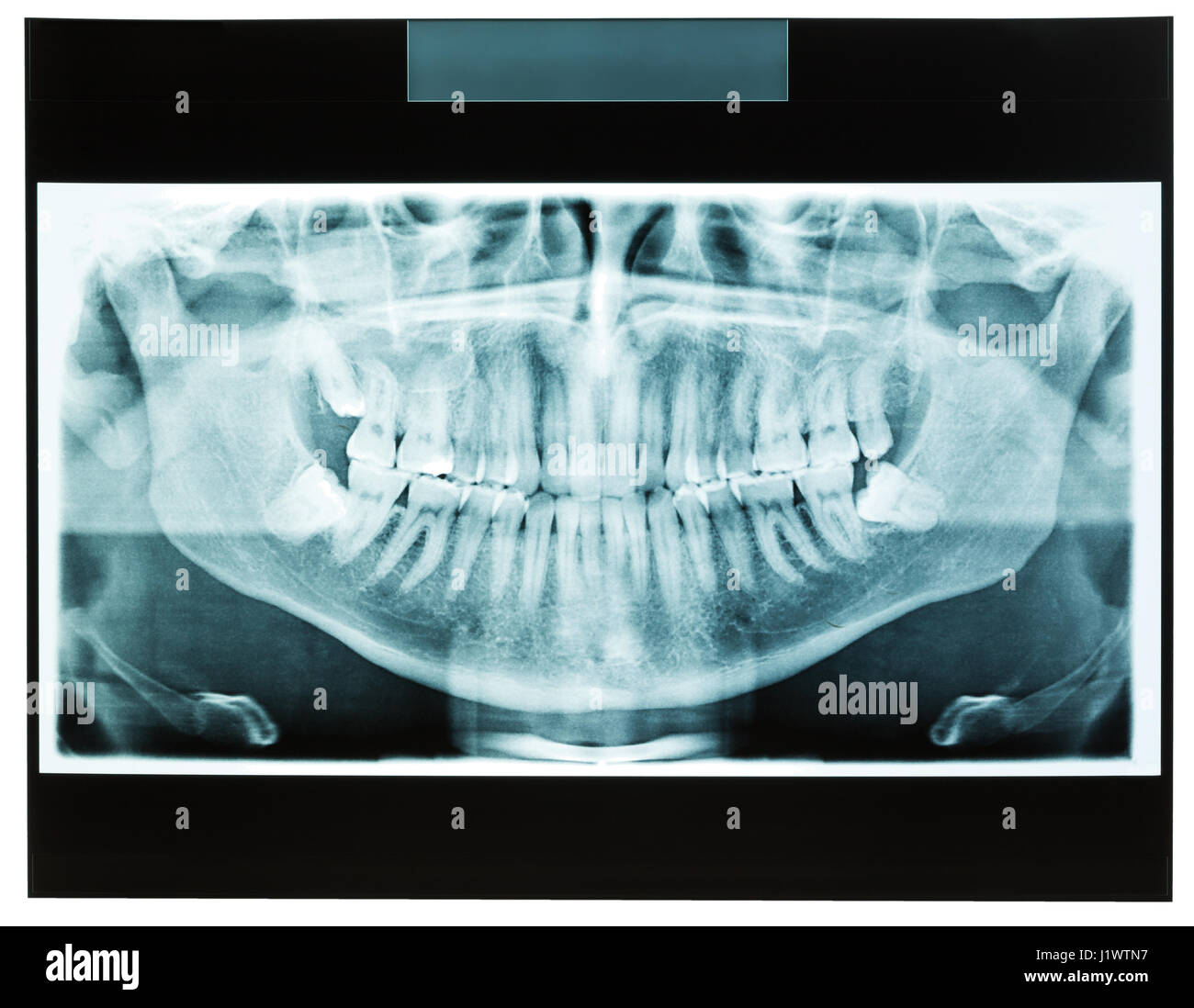 Xray of man's jaw with tooth closeup for dental orthodontic specialist and also dispositional