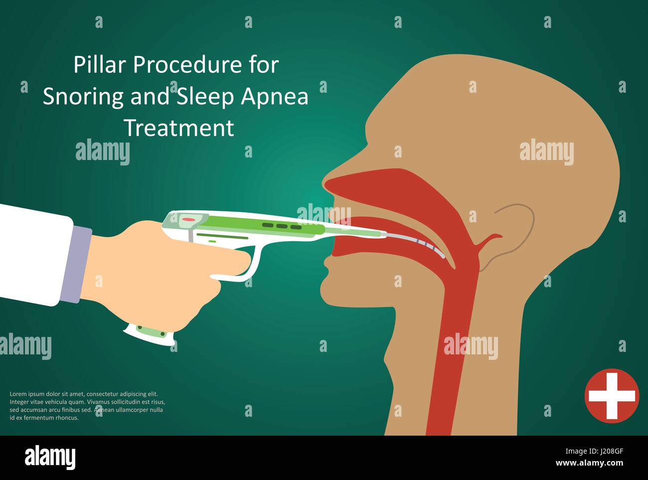 Vector illustration of procedures for sleep apnea pillar operation. Stock Vector
