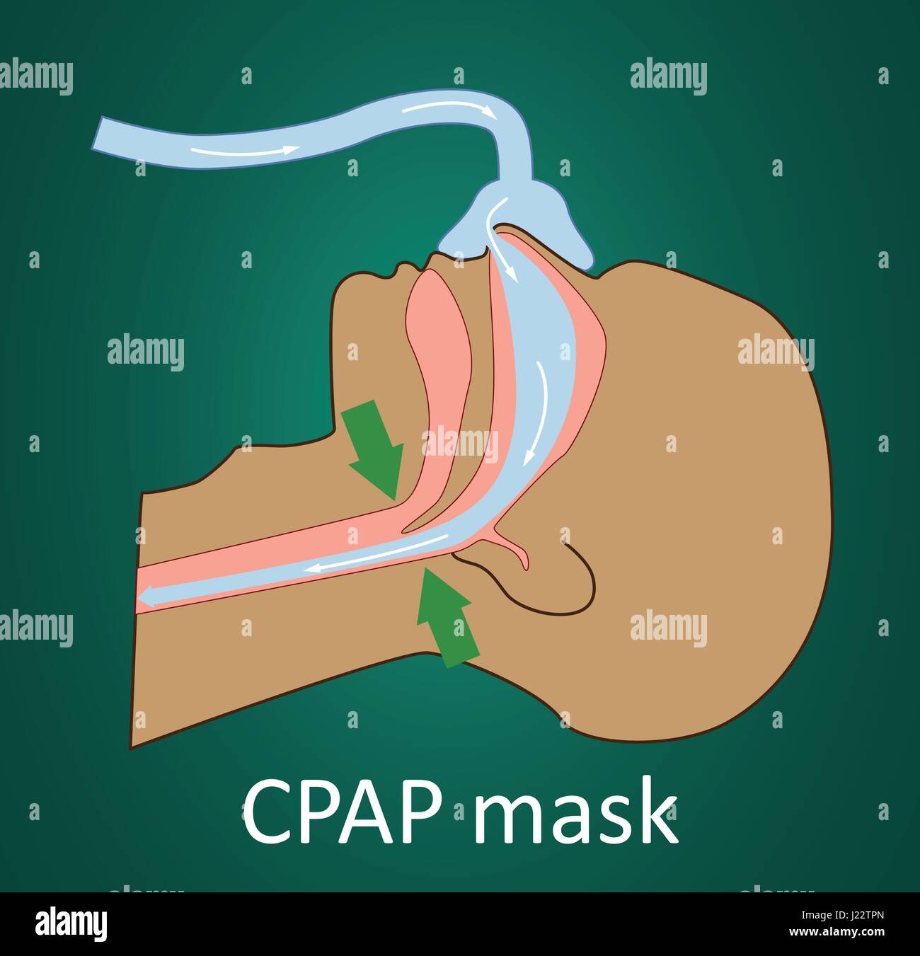 Vector illustration of normal breathing with CPAP mask. Stock Vector