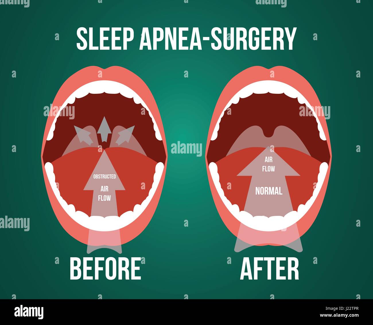 Vector illustration of surgery for obstructive sleep apnea, before and after result. Stock Vector