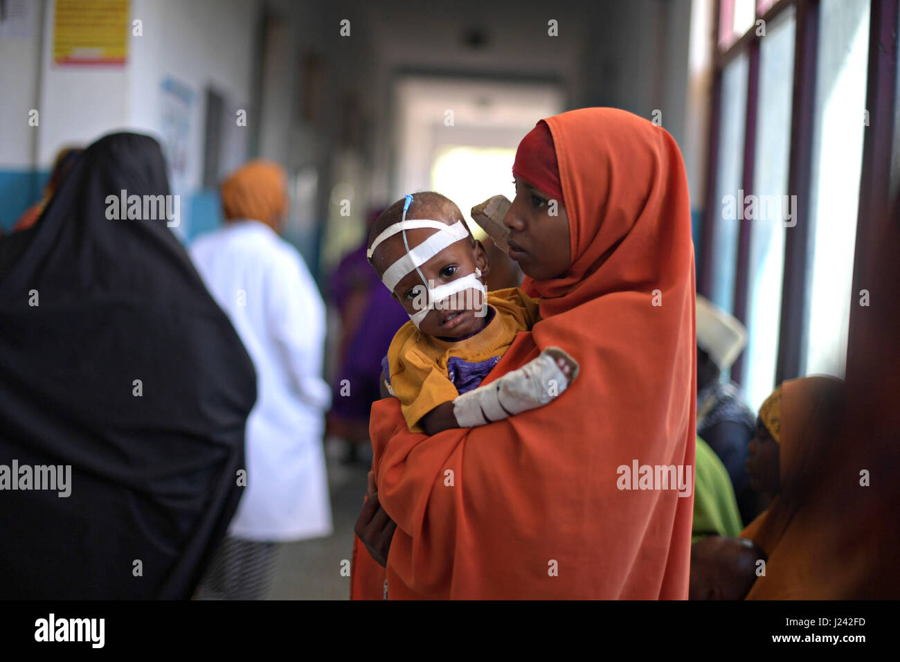 A Somalia women holds her malnourished child fitted with a nasogastric tube inside a ward dedicated for diarrhea patients at the Banadir hospital March 9, 2017 in Mogadishu, Somalia. Somalia is experiencing a severe drought, and may be on the brink of famine unless urgent humanitarian action is taken soon. Stock Photo