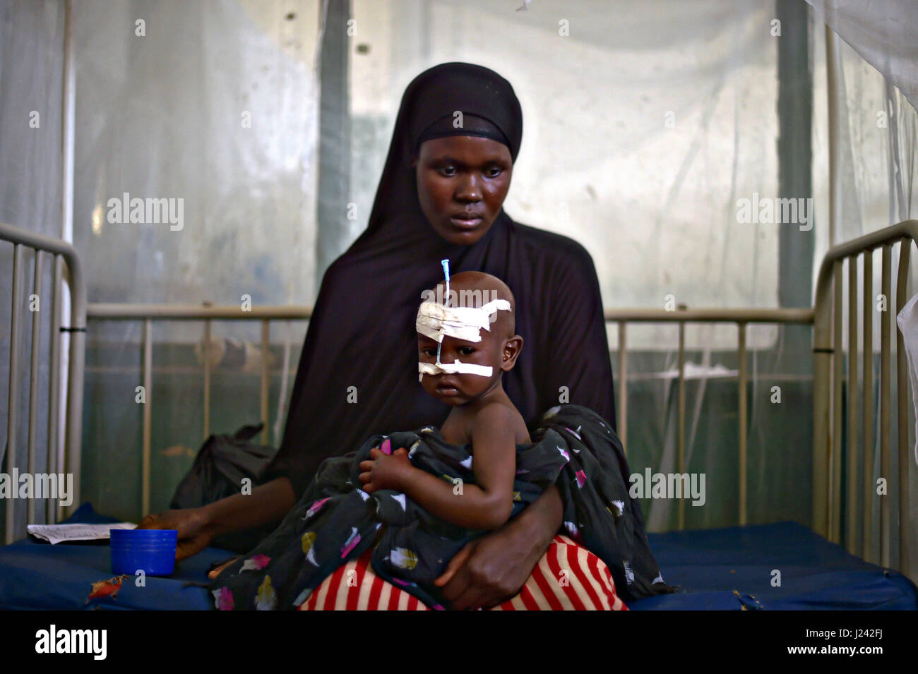 A Somalia women holds her malnourished child fitted with a nasogastric tube inside a ward dedicated for diarrhea patients at the Banadir hospital March 9, 2017 in Mogadishu, Somalia. Somalia is experiencing a severe drought, and may be on the brink of famine unless urgent humanitarian action is taken soon. Stock Photo