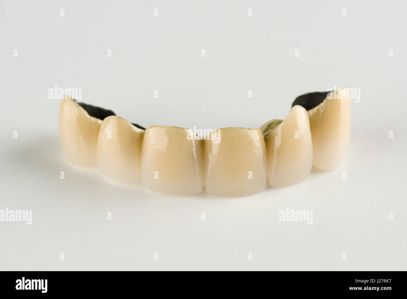 Metal-ceramic tooth crowns with locks for fixing removable prostheses ...