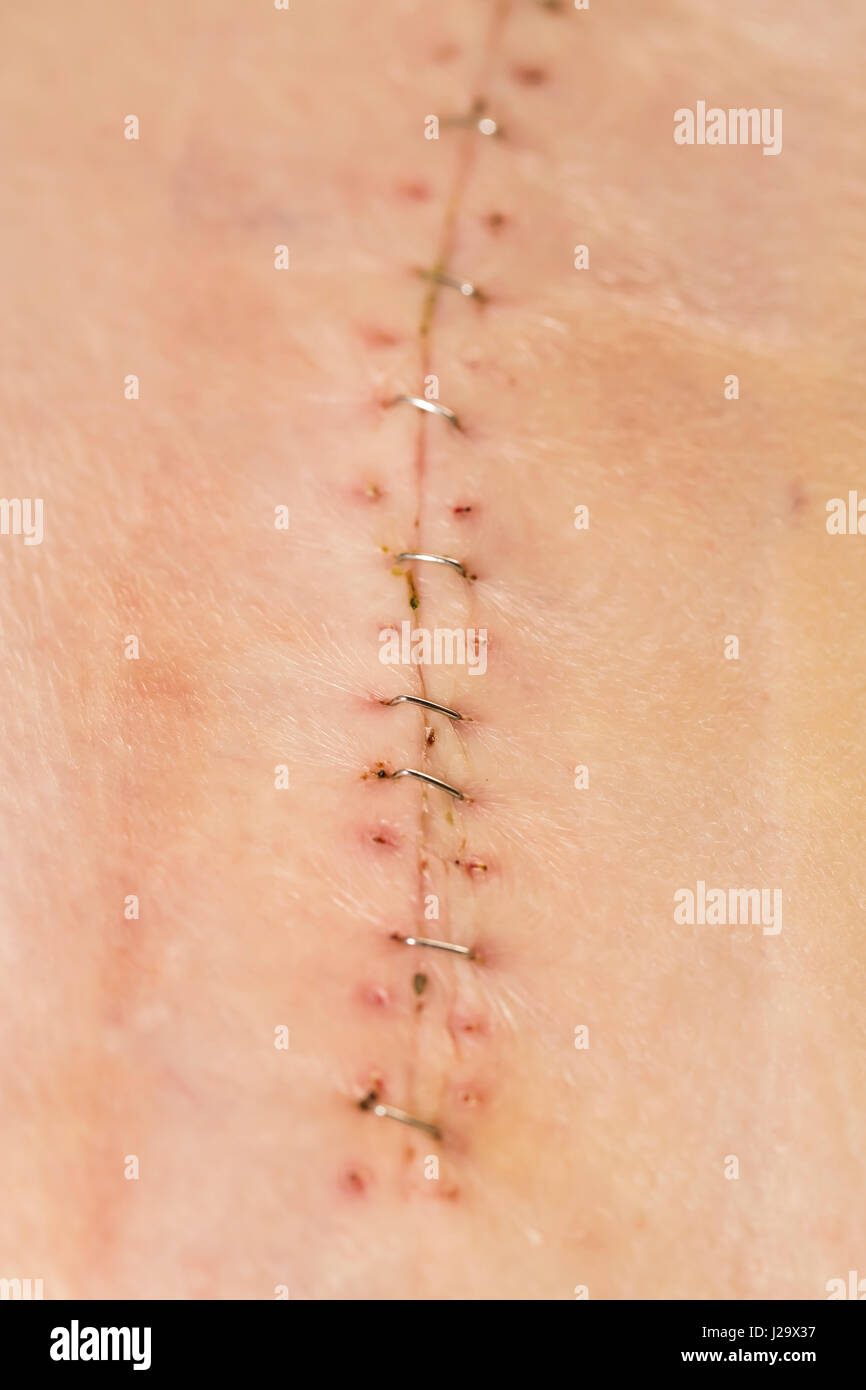 Surgical Staples Stock Photos & Surgical Staples Stock Images Alamy