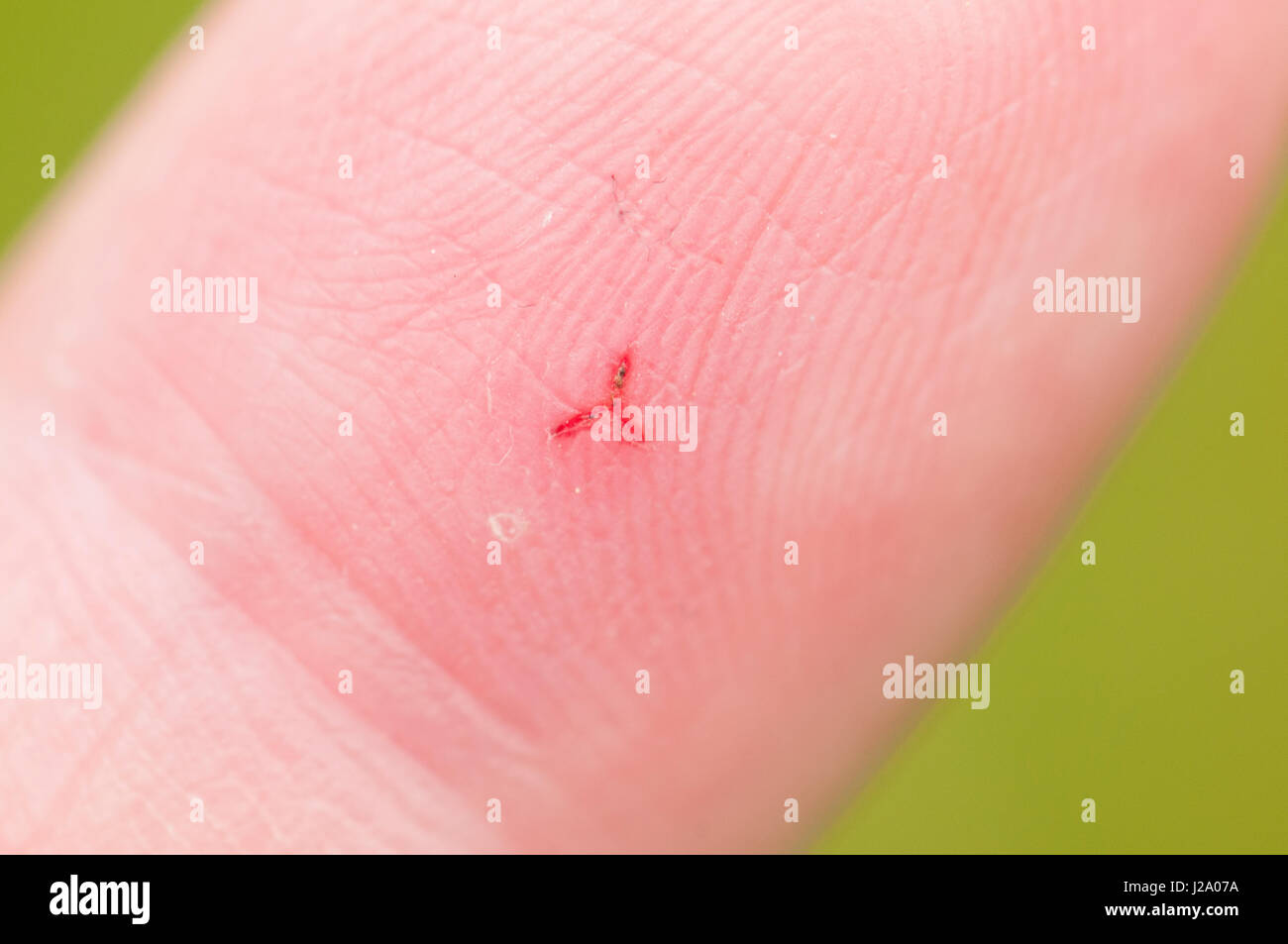 Leech bite hires stock photography and images Alamy