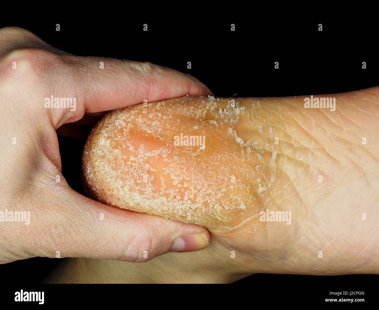 Skin peeling off from heel of an adult person, examined by podiatrist,  towards black Stock Photo - Alamy