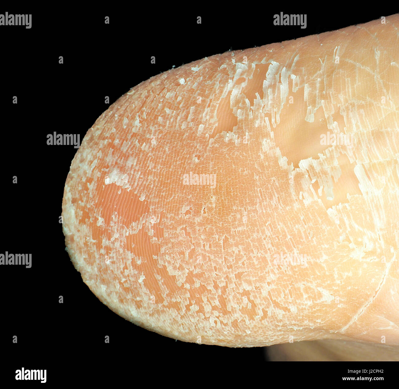 Closeup of skin peeling off from heel of foot isolated towards black background Stock Photo