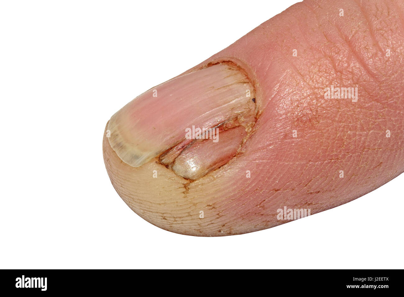 Bleeding blood from the cut finger wound. Injured finger with bleeding open cut  wound. Closeup of finger human hand is cut hurt bleeding with bright red  blood. Stock Photo | Adobe Stock