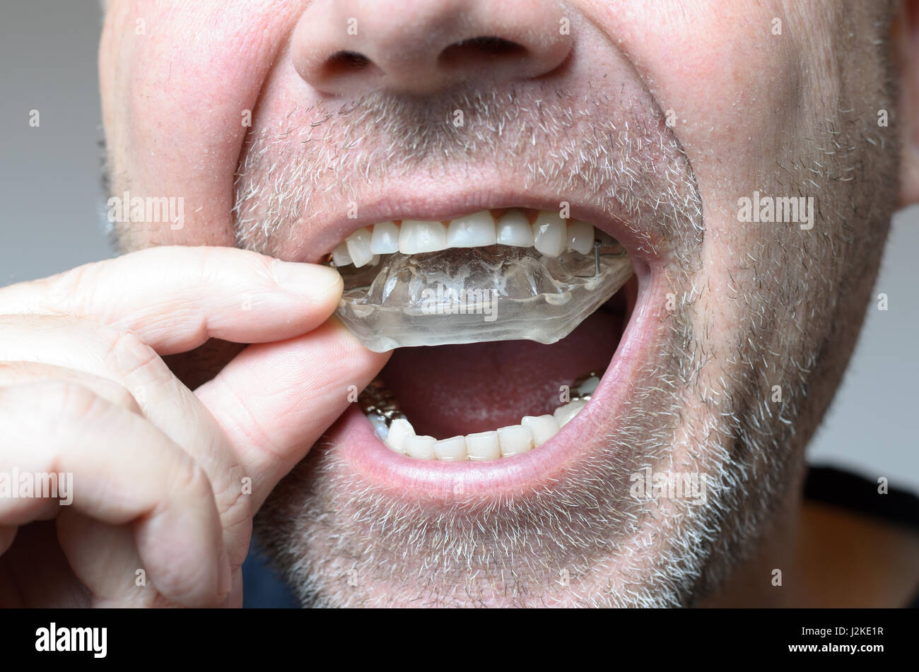 Man placing a bite plate in his mouth to protect his teeth at night