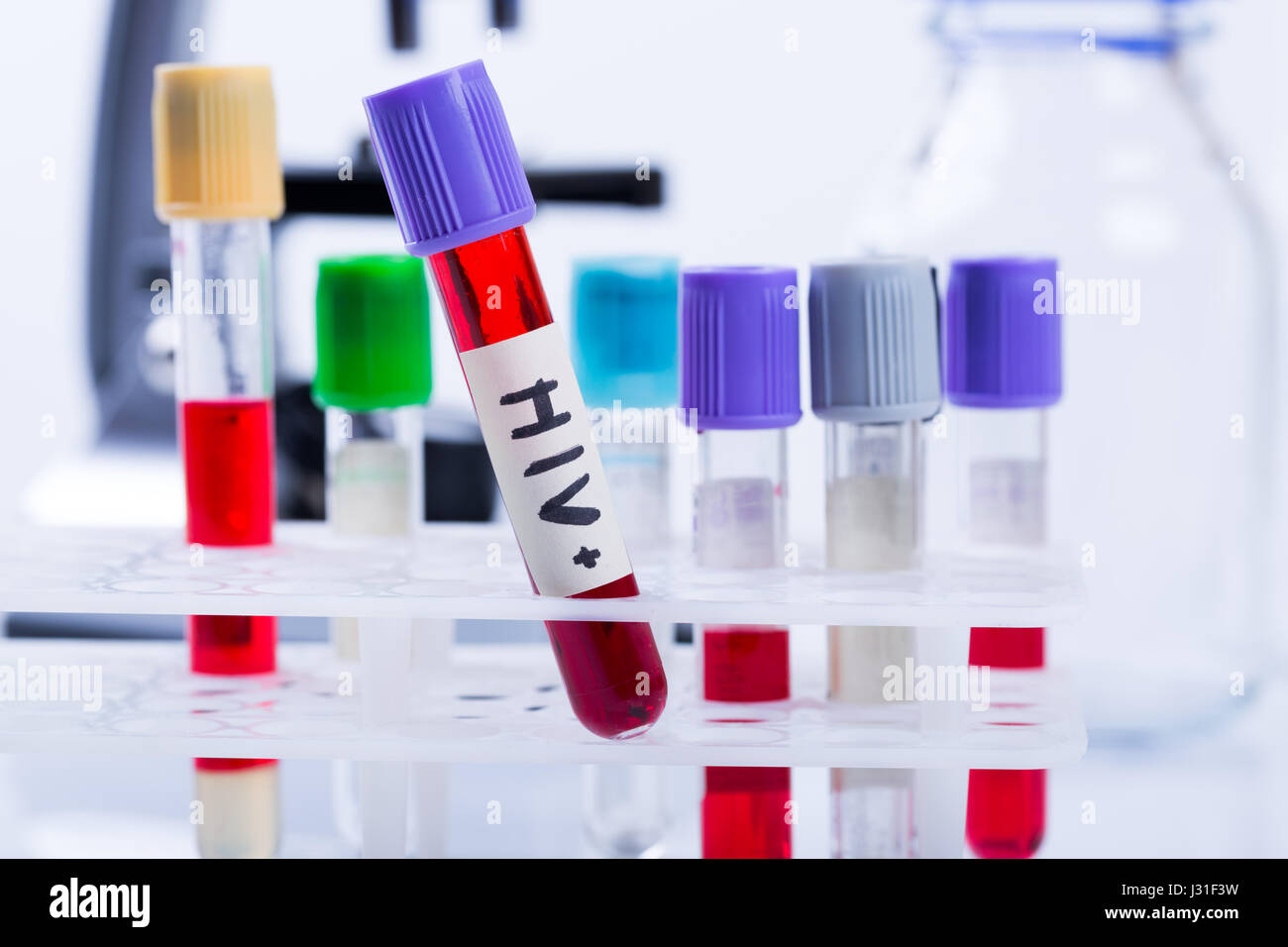 tubes with hiv test blood samples in laboratory Stock Photo