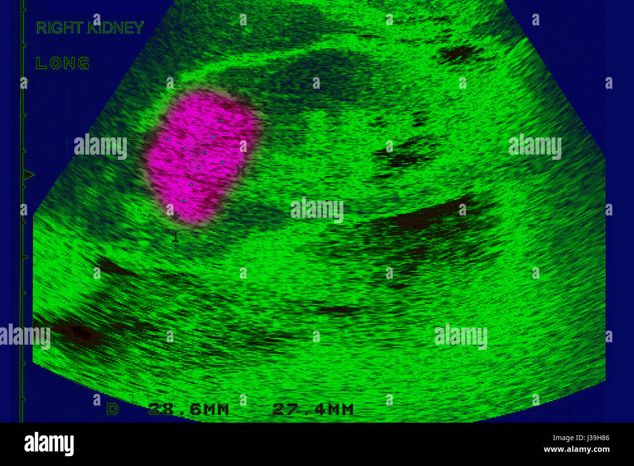 Ultrasound kidney renal hires stock photography and images Alamy