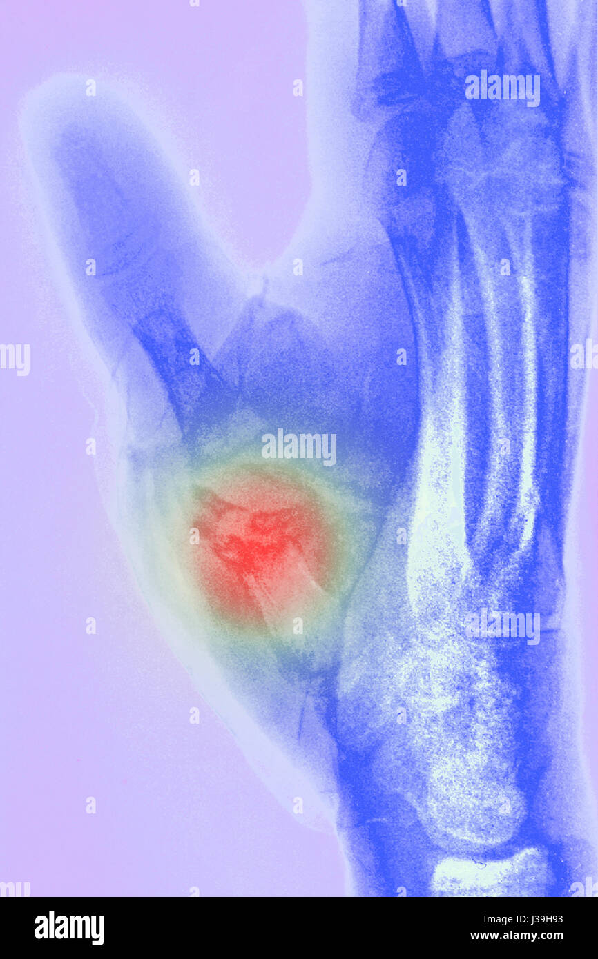 FRACTURED HAND, X-RAY Stock Photo