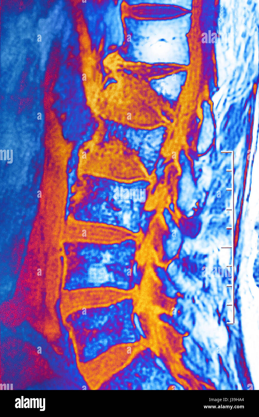Compression fracture spine hires stock photography and images Alamy