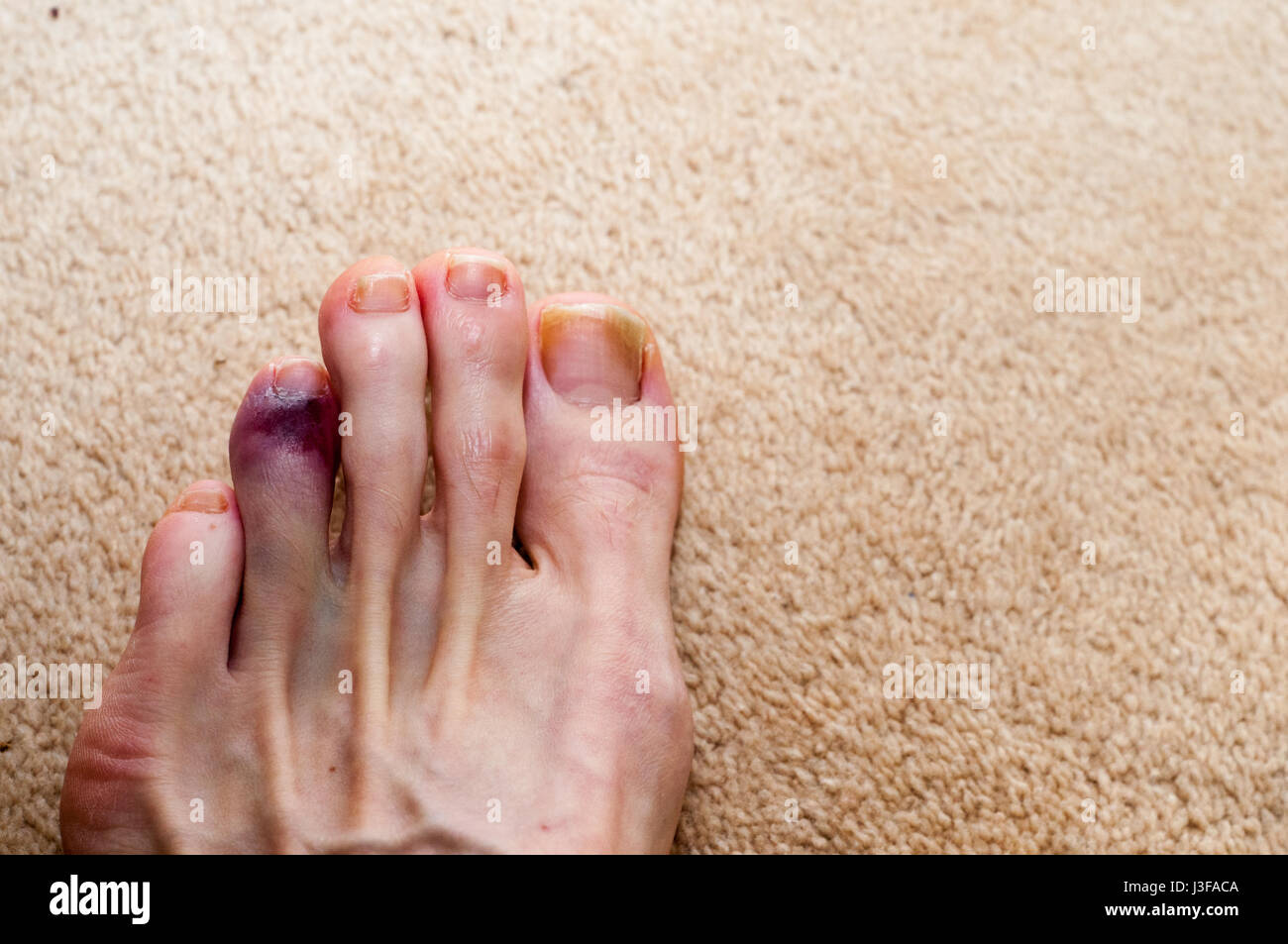 Broken toe showing bruising on skin due to injury Stock Photo Alamy