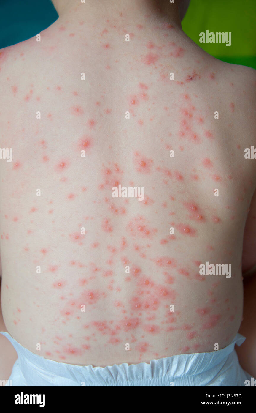 A baby boy showing his back with chicken pox Stock Photo