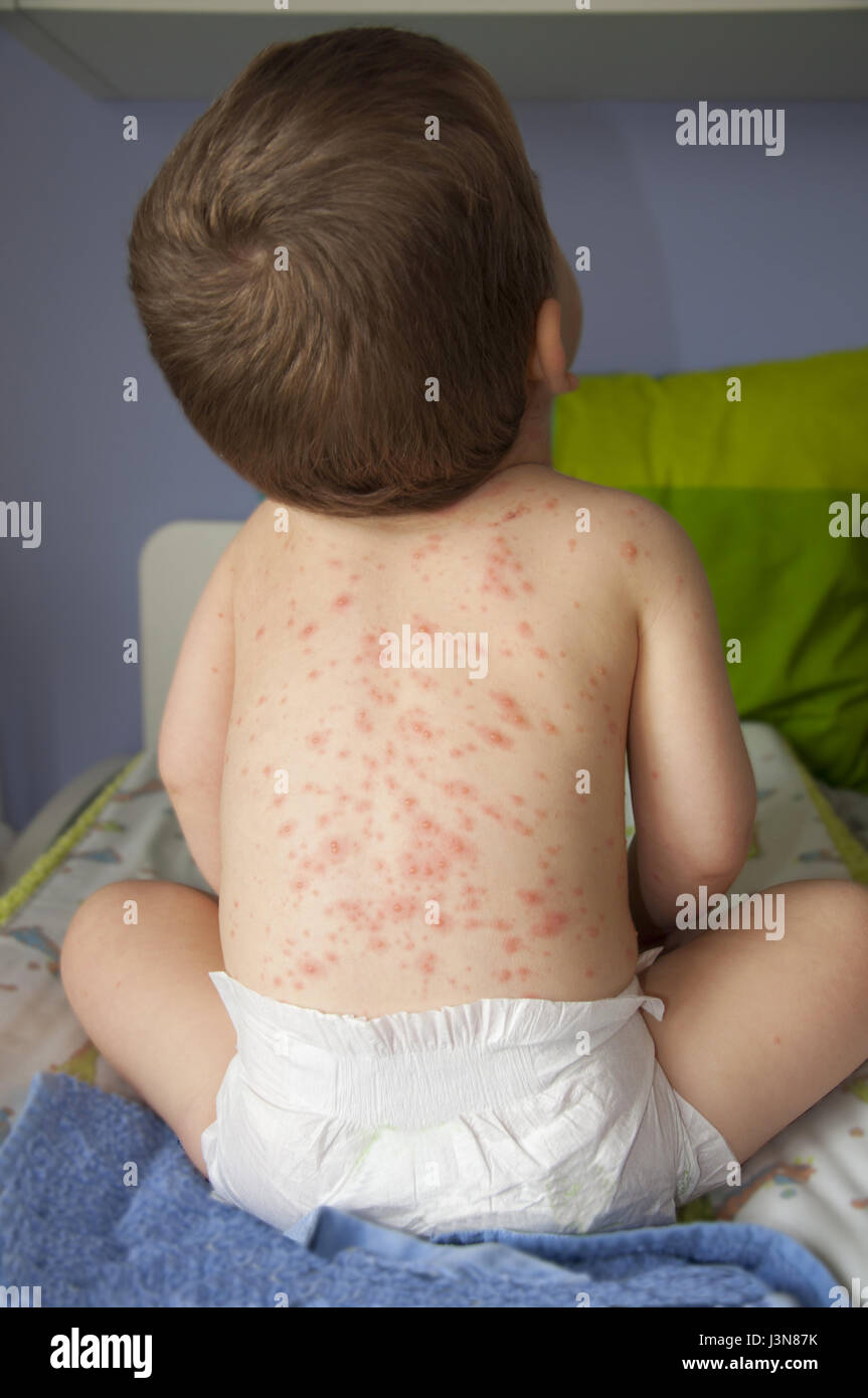 A baby boy showing his back with chicken pox Stock Photo