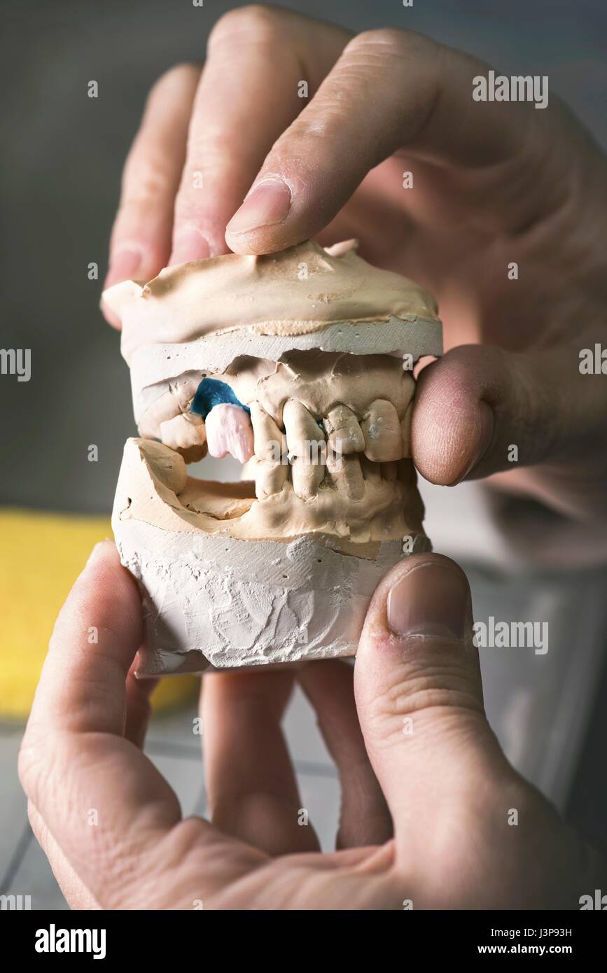 Dental Mold With Prosthetic Tooth, Close Up Stock Photo - Alamy