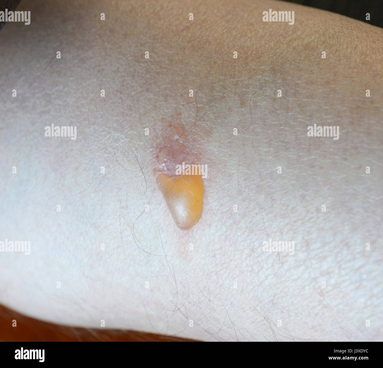 Leech Bite Stock Photos & Leech Bite Stock Images Alamy