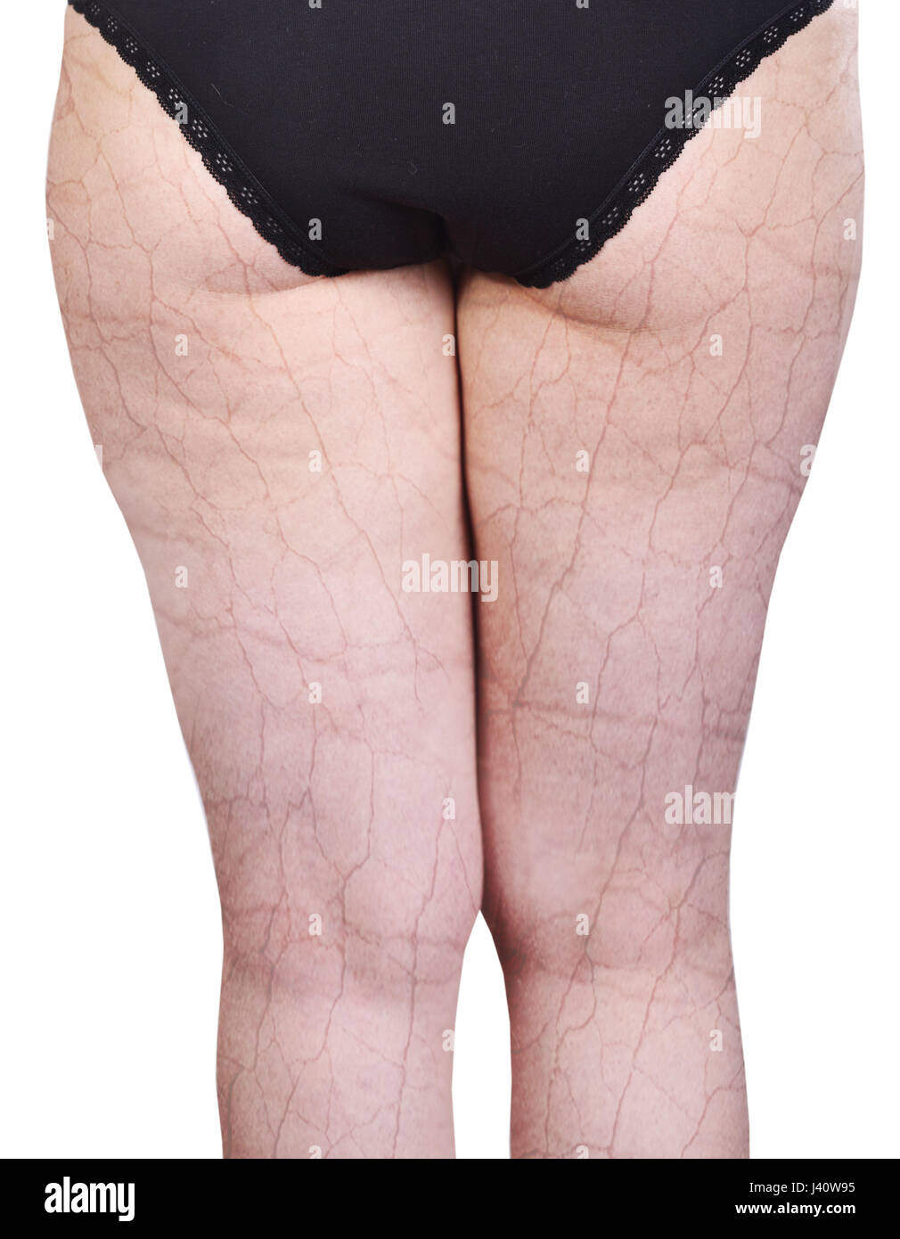 Cellulite legs hires stock photography and images Alamy