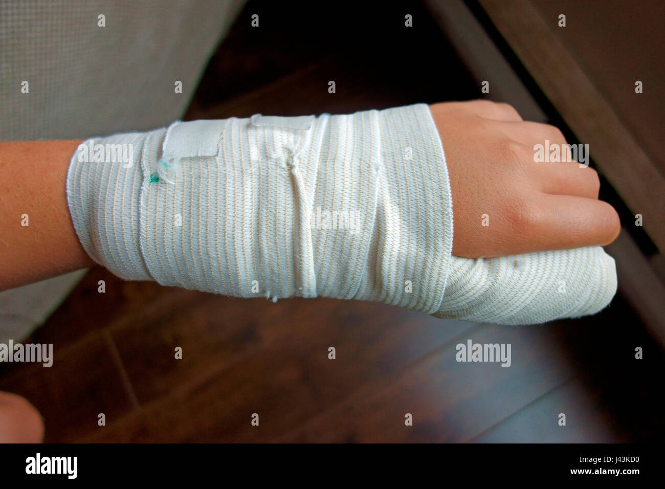A cast on the arm and hand of a 12 year old boy who has a broken thumb Stock Photo