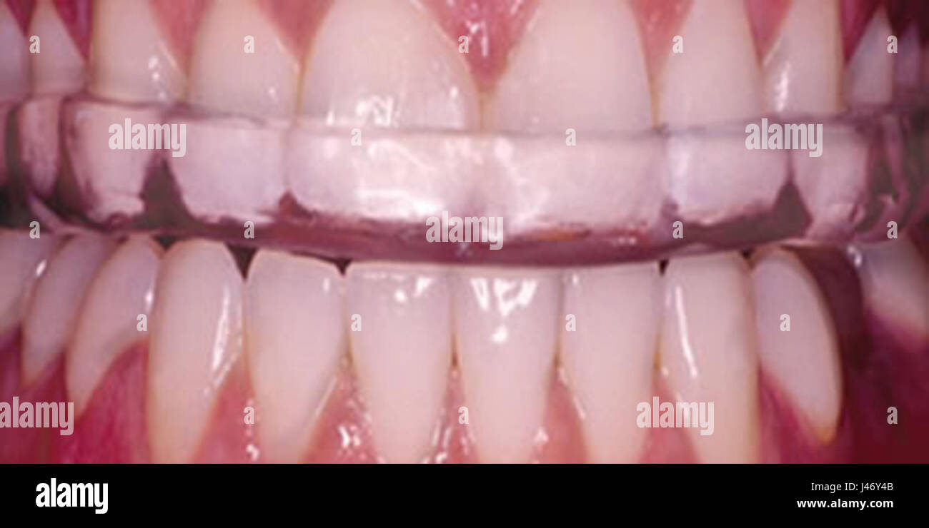 Patient Wearing Occlusal Splint Stock Photo Alamy