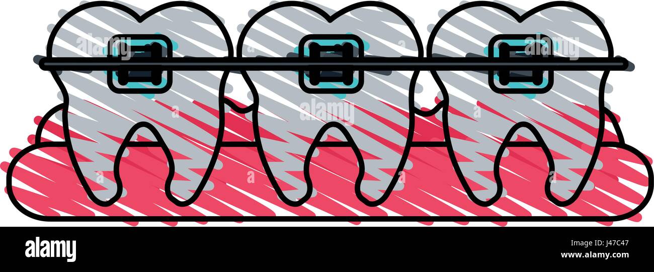color crayon stripe cartoon set gum with tooth view and orthodontics Stock Vector