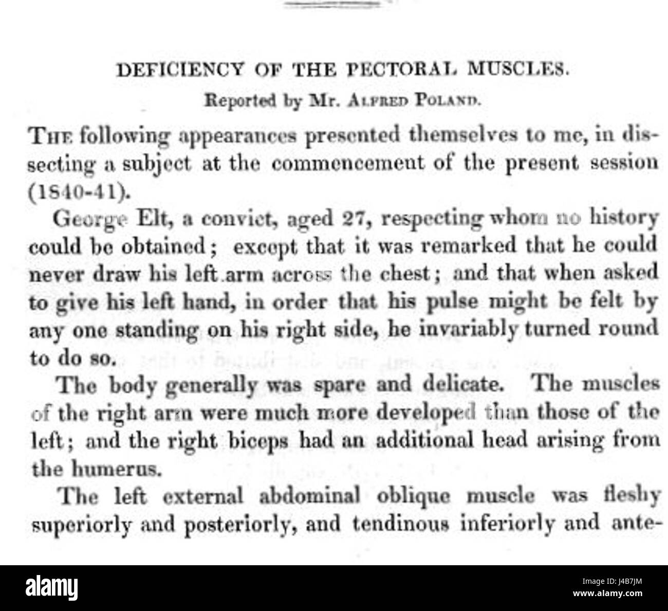 Poland syndrome description Stock Photo - Alamy