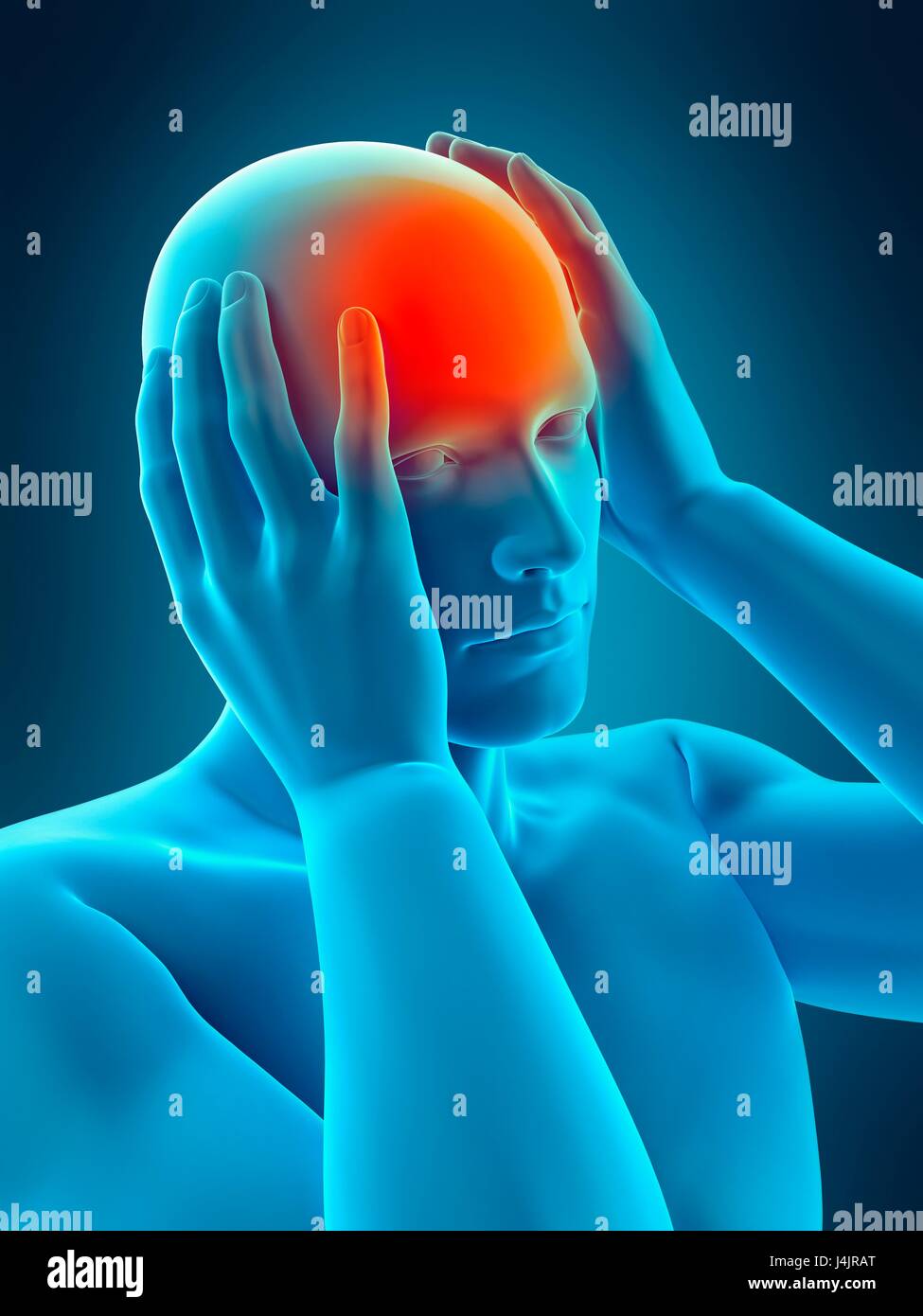 Person with headache, illustration Stock Photo Alamy