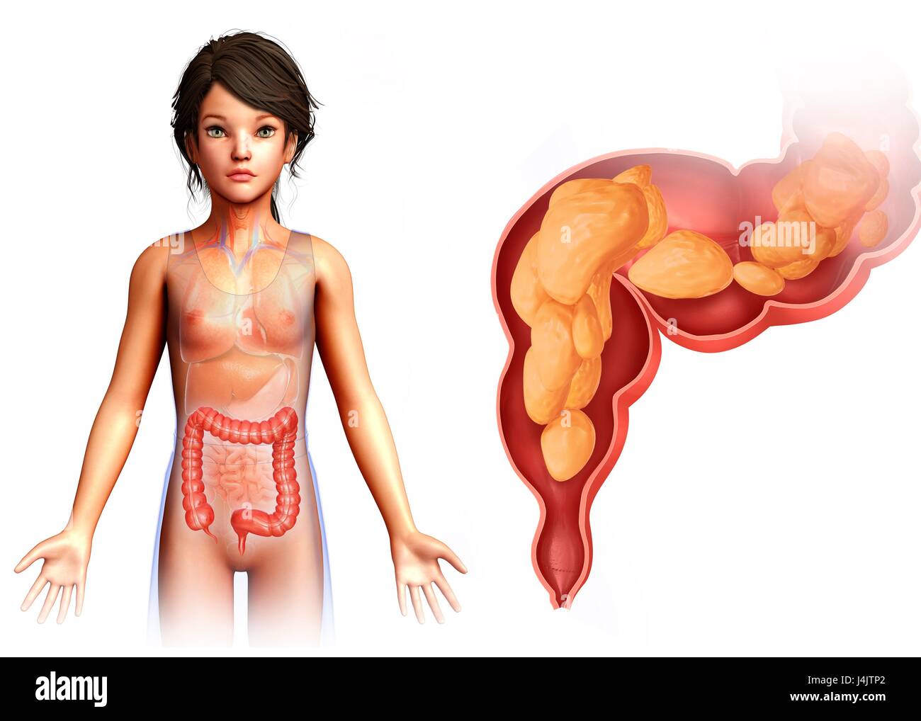 Illustration of a child's rectum. Stock Photo