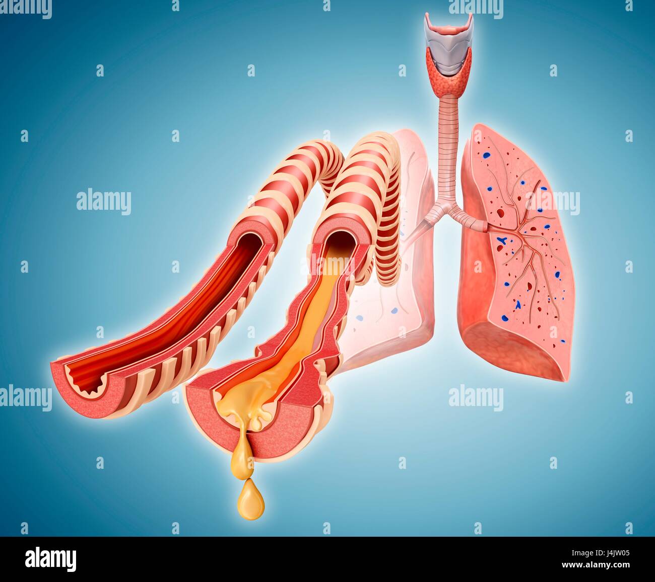 Illustration of normal and infected lung bronchi. Stock Photo