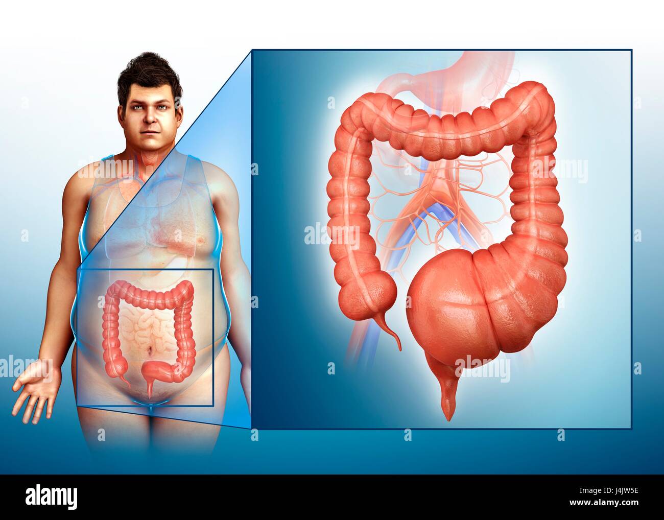 Токсический мегаколон. Болезнь гиршпрунга у детей на рентгене. Идиопатический мегаколон. Токсико идиопатический мегаколон. Токсический мегаколон.