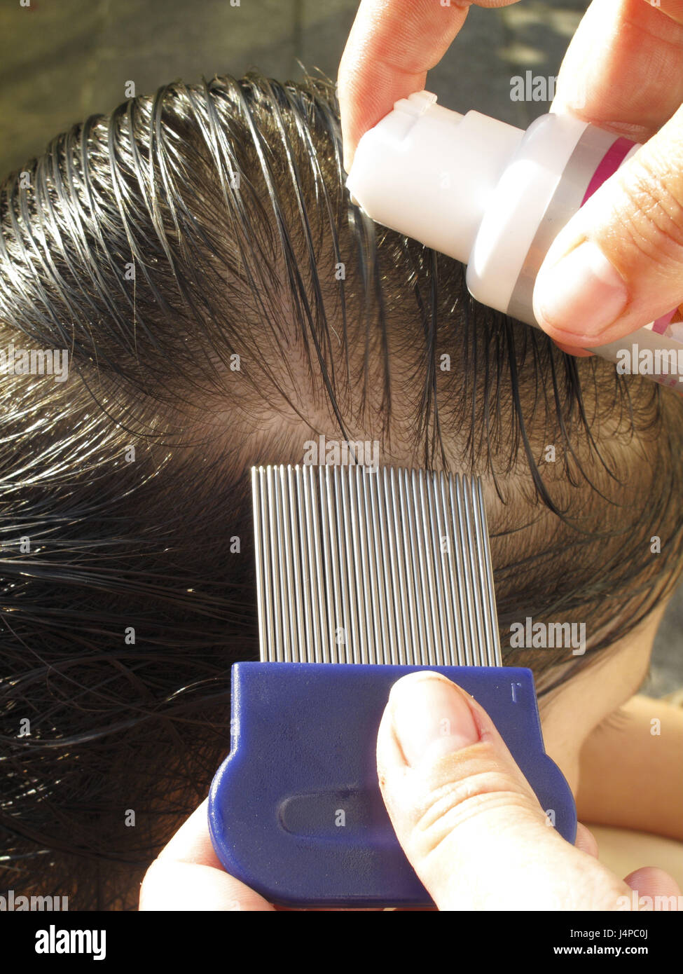 Hair lice removal hi-res stock photography and images - Alamy