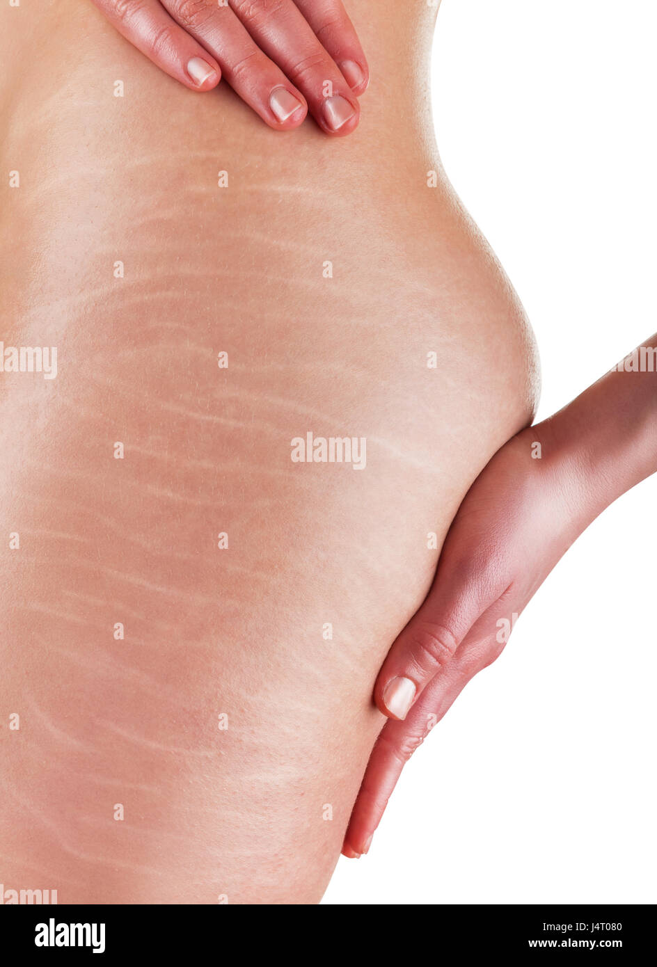 A woman is testing the skin on the thigh for the presence of stretch marks and cellulite Stock Photo