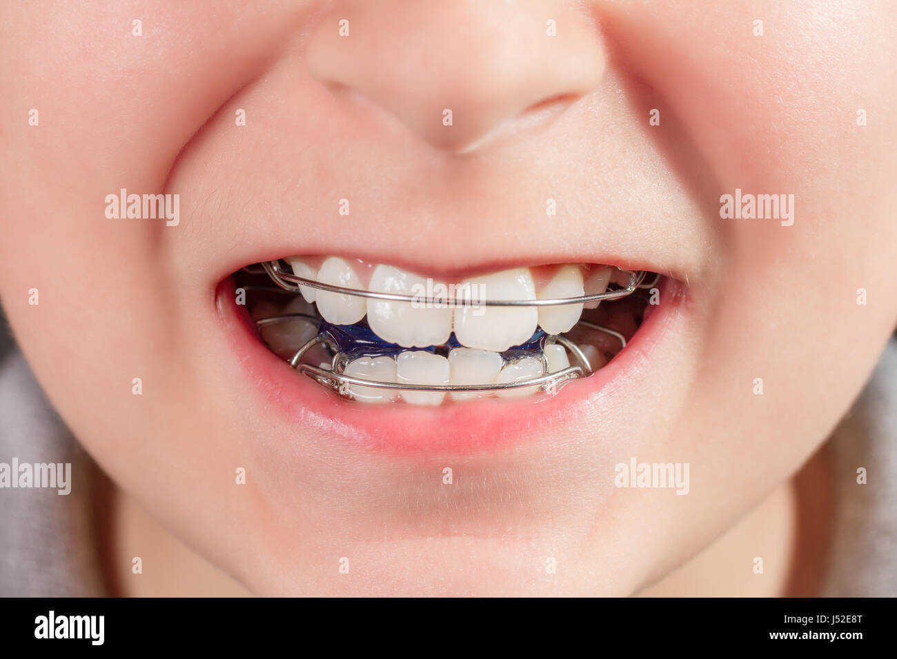 Orthodontic appliance hires stock photography and images Alamy